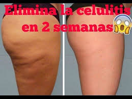 Como Eliminar La Celulitis De Las Piernas Y Gluteos Rapidamente Pin En Remedios Para Celulitis