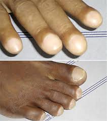 Image result for Clubbing nails feet