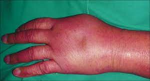 Purple Glove Syndrome Wikem