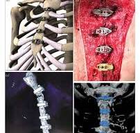 Schematic of the titanium-alloy sternal fixation system. (a ...