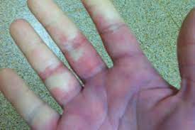 My Hands And Feet Are Always Cold Should I Worry Health Essentials From Cleveland Clinic