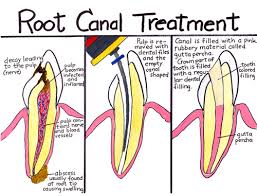Jun 20, 2014 · the swelling indicates that your body still has an infection that it is having trouble fighting. Root Canal Therapy Columbia Sc Dr Adam Hahn