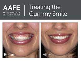 May 19, 2020 · botox helps to fix a gummy smile by relaxing the muscles of your upper lip. Gummy Smile Correction In Houston Tx Westchase Mdrn Dental