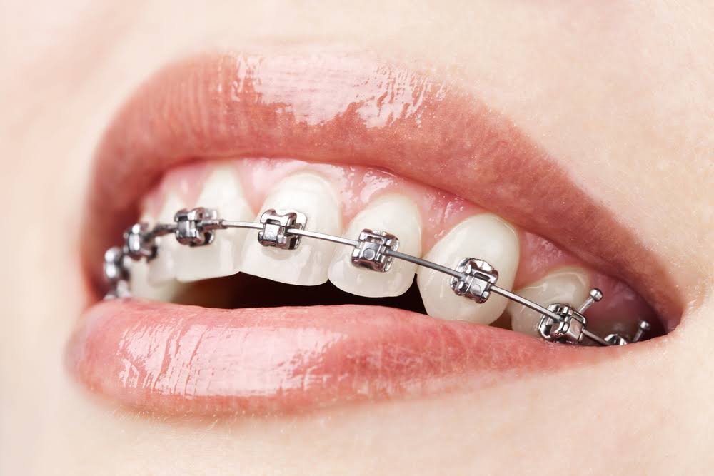 Metal Braces product image