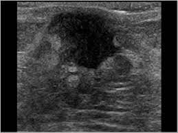 In its early stages, breast cancer usually does not cause pain and may exhibit no noticeable symptoms. Breast And Axilla 5 8 Male Breast Case 5 8 2 Malignant Breast Tumors In Male Patients Ultrasound Cases
