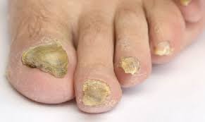You may be wondering what the other symptoms of toenail fungus infection are. Thick Toenails Diagnosis Treatment Foot Pain Explored