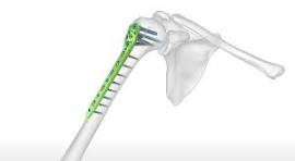 Polarus Proximal Humeral Plating System | Acumed