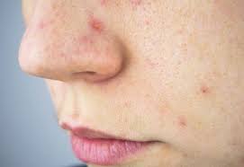 La frente, mejillas y un lado de la nariz son las áreas afectadas más comunes. Tratamientos Contra El Melasma Mirnatherapeutics