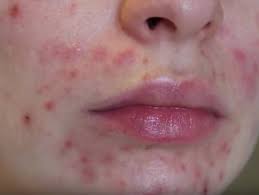 Cat acne is most common on the chin or around the mouth, but it can be present anywhere on the body. Adult Acne Symptoms Diagnosis Treatment And Information