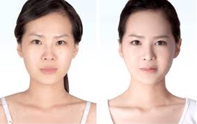 Cấy mỡ tự thân có được vĩnh viễn không? 3 lưu lý quan trọng