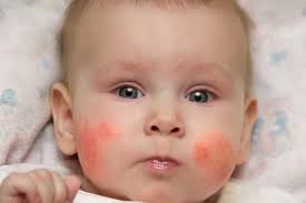 Sensitive skin is prone to rashes, infections and allergies. How To Treat Baby Rashes At Home Tips And Remedies