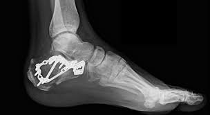 Image result for Calcaneus Compression Fracture