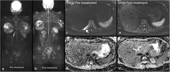 Tion of metastatic breast cancer without current breast signs. Imaging Diagnosis Of Metastatic Breast Cancer Insights Into Imaging Full Text