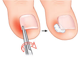 Durere de spate cu furnicături ale degetelor de la picioare. Tratament Pentru Unghia IncarnatÄ Seki Edge Romania Blog