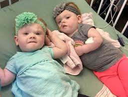 If the twins share their vital organs, such as the heart, then the two of them die. Taking A Look At The Miraculous Conjoined Twins Years Later