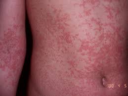 Resultado de imagem para pessoas com dengue manchas