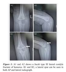 Image result for Lateral Condyle Fracture
