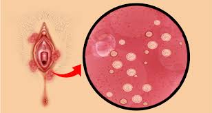 Image result for Phimosis