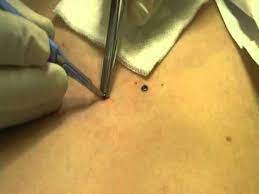 Microdermal Dermal Anchor Removal Hip Dermal Piercing Dermal Anchor Dermal Piercing
