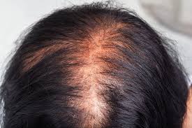 Scalp micropigmentation is the #1 hair loss solution for men and women who want to achieve the appearance of natural and thick hair. How Hair Colour Affects Scalp Micropigmentation Luxe Micro