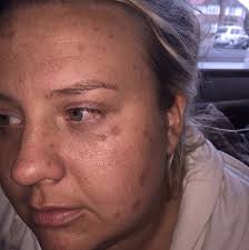 Jamie O'Hara posts a picture of a hole in his cousin's head after acid  burnt through her scalp in London attack which saw Ferne McCann's  ex-boyfriend appear in court