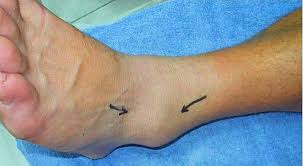 A grade 2 sprained ankle should not be treated at home unless you or someone who can care for you is a medical professional. How Long Is Too Long For A Sprained Ankle To Heal Ask The Doctor