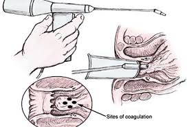 Occasionally, the tag is large. How To Get Rid Of Hemorrhoids Types Causes And Treatments