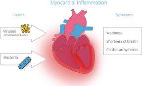 However, more than half of the cases (52.5%) of heart inflammation have come. Heart Muscle Inflammation Myocarditis Cardiosecur