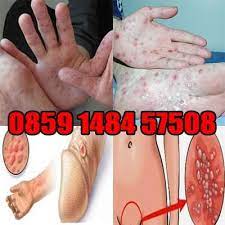 Gejala sifilis diawali dengan munculnya luka yang tidak terasa sakit di area kelamin, mulut, atau dubur. Sipilis Adalah Penyakit Obat Sipilis Di Apot Sipilis Pada Pria Sipilis Wanita Sipilis Pada Wanita Obat Sipilis Apotik