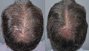 You can't show up with a huge bald spot and expect great results. Prp Archives Hair Loss Cure 2020