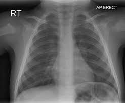 Pediatric Chest Ap Erect View Radiology Reference