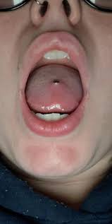 Got My Tongue Pierced A Week Ago. Is This Normal Due To Swelling? The Ball  Sitting Flush With My Tongue. The Piercer Did Put A Long Bar In And My  Cousin Who