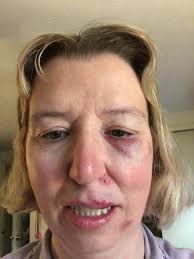 Beverly Farms Library Talk Cancellation due to Injury