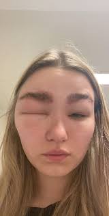 Allergic Reaction to Tinted Eyebrows