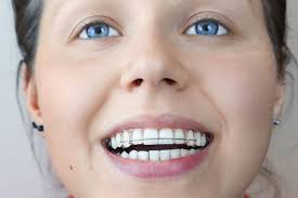 Prolonged usage may extend up to a year or more. What Happens When Your Retainer No Longer Fits