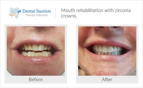 Dental Implant Clinic Top Results Dental Implants Infographic Dental Implants Cost Dental Implants