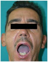 Osteochondroma of Coronoid Process: A Rare Etiology of Jacob Disease