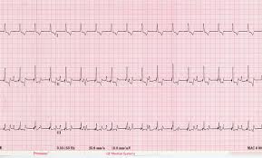 Classification follows pacemaker code developed by the north american society of pacing and electrophysiology (naspe) and the british pacing and electrophysiology group (bpeg). Ecg 19