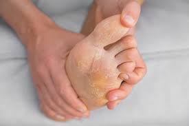 Athlete's foot is a common, highly contagious fungal infection that affects the feet. How To Disinfect Shoes From Athlete S Foot Pasunautre
