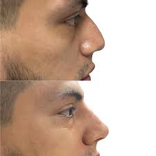 Transforma tu nariz en solo unos minutos con la rinomodelación de ácido  hialurónico! 😍 Este procedimiento no quirúrgico puede mejorar la forma y  simetría de tu nariz de manera rápida y efectiva,