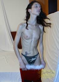 Anorexic Girl (80 photos) - porn