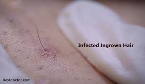 Can it be something else? go to your doctor: How To Treat Infected Ingrown Hair