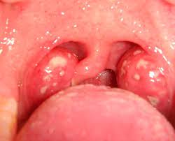 Questo agente virale appartiene alla stessa famiglia degli herpes virus, ovvero la . Esami Mononucleosi Esami Clinici Esame Mononucleosi