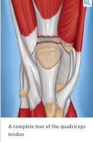 Every muscle in your body is attached to bone by tendons. All About Patellar Quadriceps Tendon Tears 321gomd