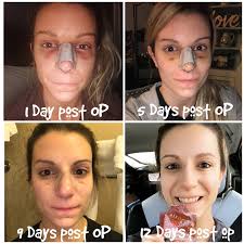 Septoplasty Rhinoplasty Recovery Using Essential Oils Rhinoplasty Recovery Rhinoplasty Nose Job Recovery