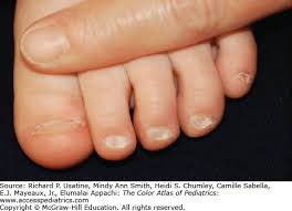 Image result for Koilonychia feet