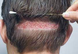 History Of Hair Transplant Treatment | Other Resources