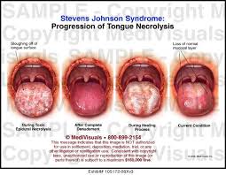 Stevens Johnson Syndrome Google Search Steven Johnson Steven Johnson Syndrome Syndrome
