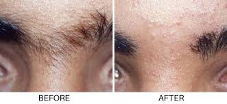 Laser hair removal in washington, dc is performed by performing a series of laser pulses over the area to be treated. Laser Hair Removal Permanent Hair Reduction In Northern Virgina