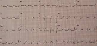 Prolapso mitral com regurgitação mitral. Myokarditis Wikiwand